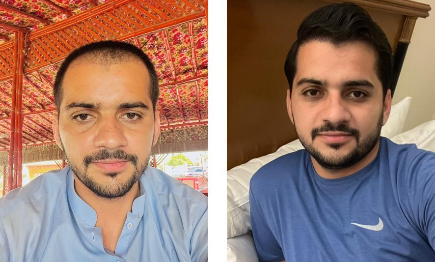 Before and after hairline restoration, front view, Abdullah Clinics Karachi