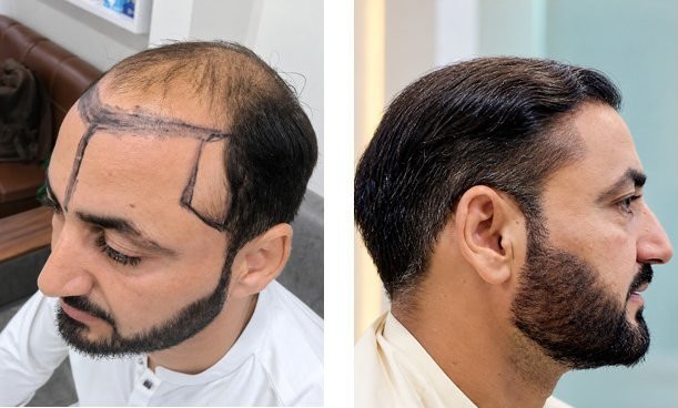 Before and after hair transplant result, side view, Abdullah Clinics Karachi