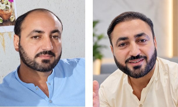 Before and after hair transplant result, front view, Abdullah Clinics Karachi