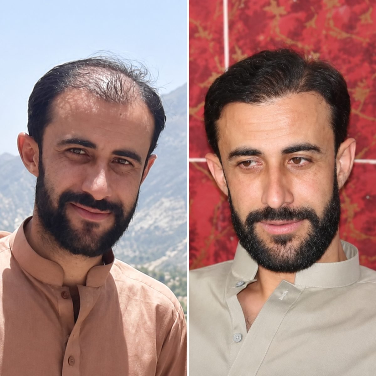 Before and after hair restoration result, Karachi